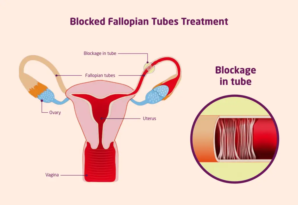 Blocked Fallopian Tubes Treatment