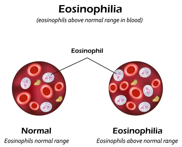 Obturador de eosinofilia 355493819