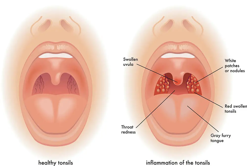 Illustration einer Mandelentzündung 8bcafb